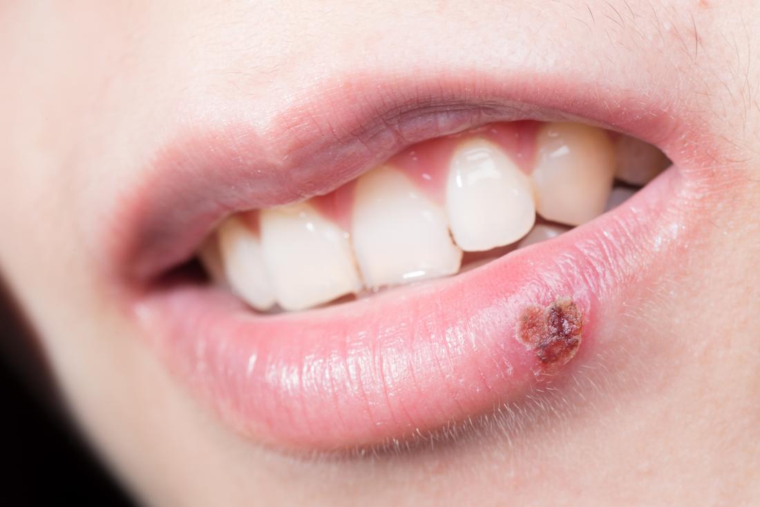 What makes cold sores appear