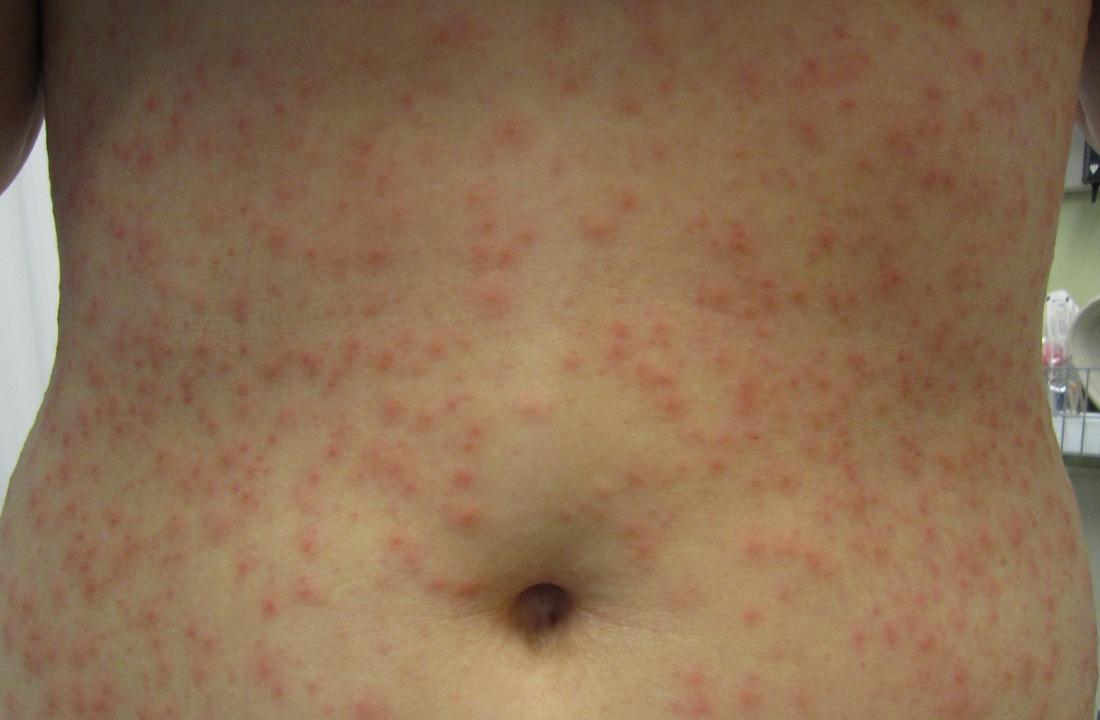 Hot Tub Folliculitis Pictures Symptoms Diagnosis Treatment