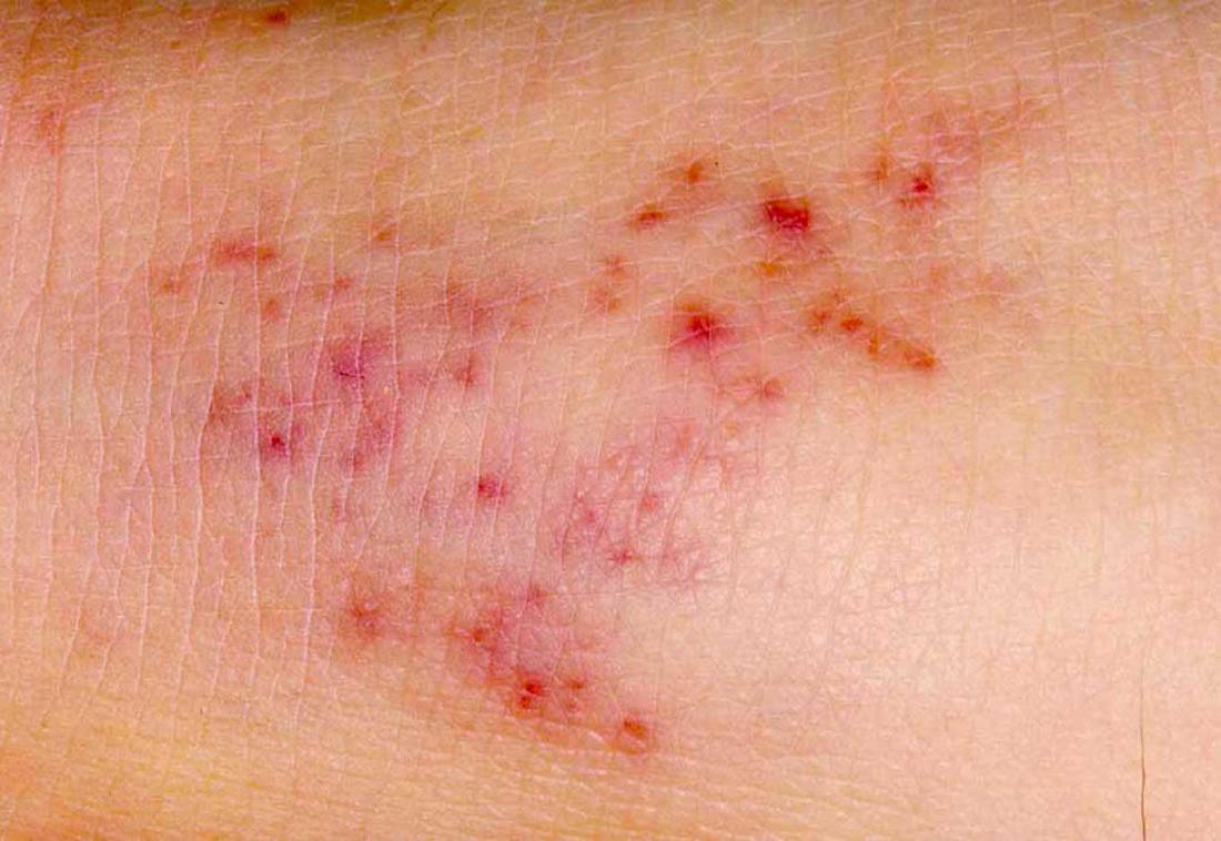 Meningitis Rash Pictures Symptoms And Similar Rashes