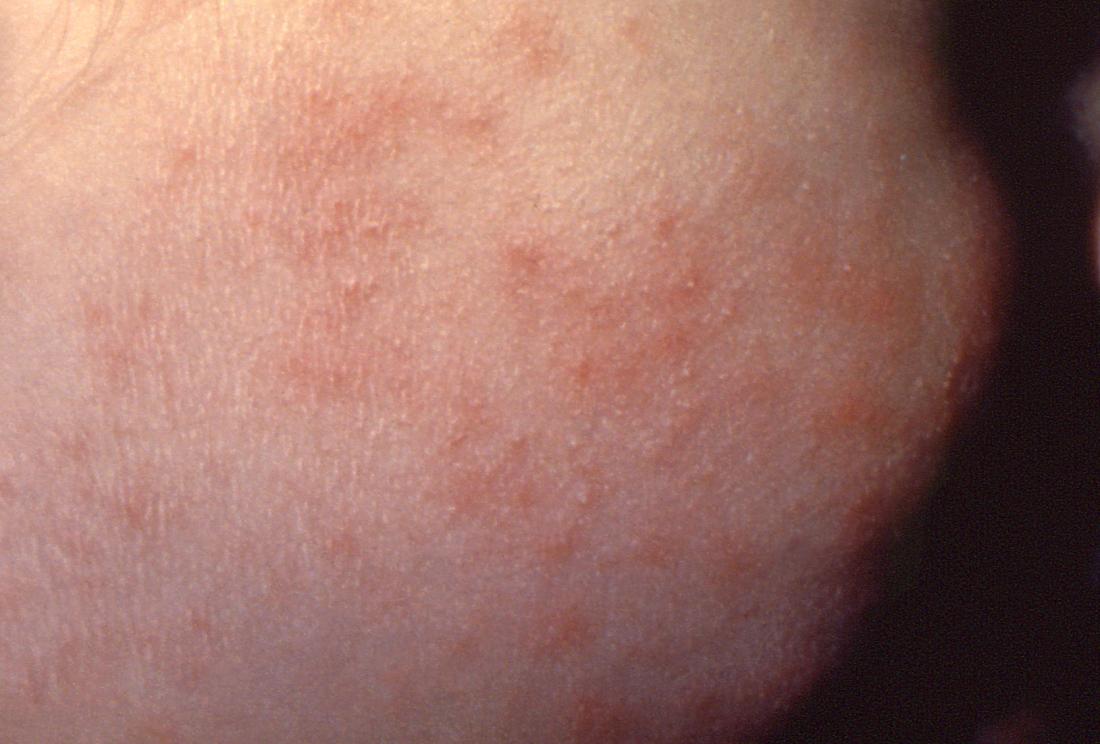 azathioprine pinpoint red spots on skin