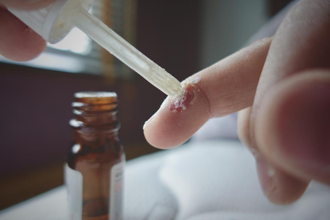 wart removal medicine