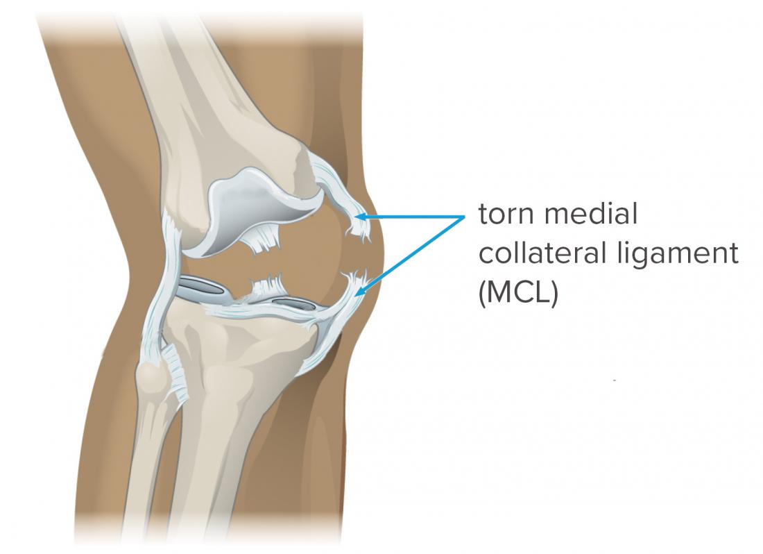 medial collateral ligament MCL tear picture