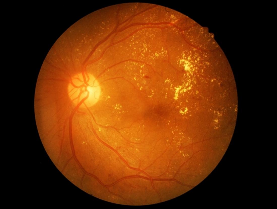 diabetic retinopathy header