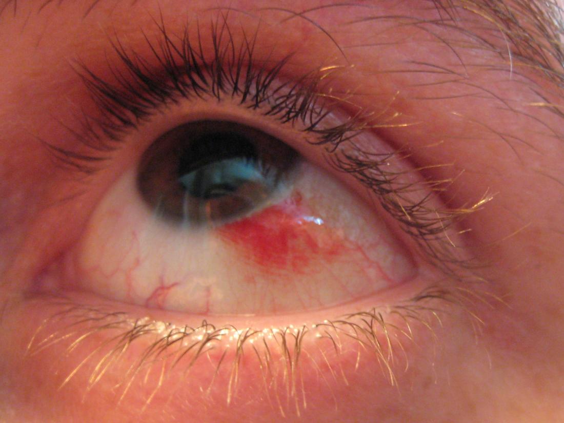 Red Spot On Eye Causes And Treatment