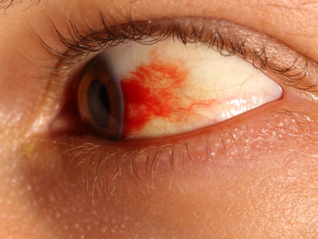 blood spot in eye