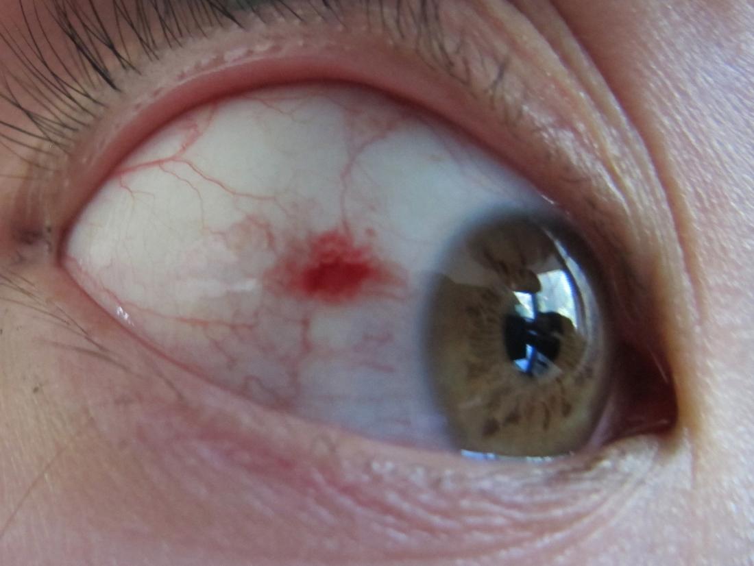 blood spot in eye