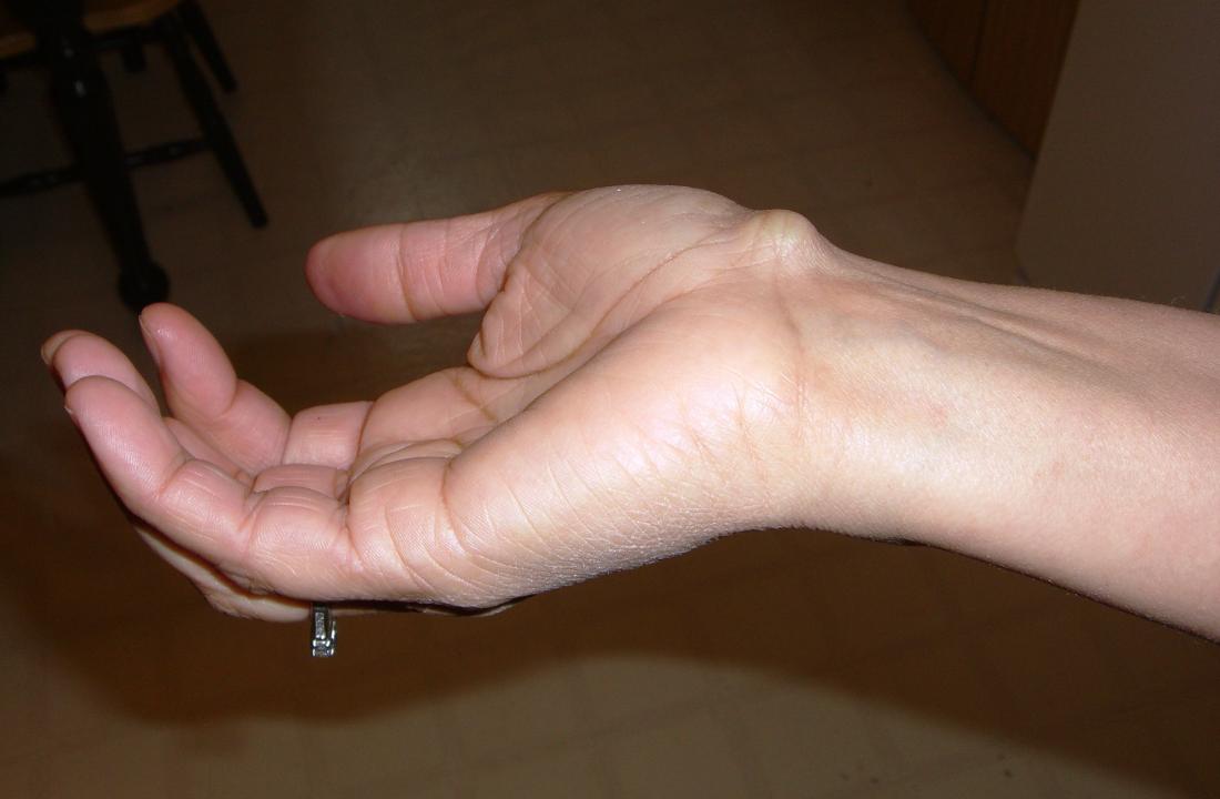 ganglion cyst on wrist. Image credit: GEMalone, 2008.