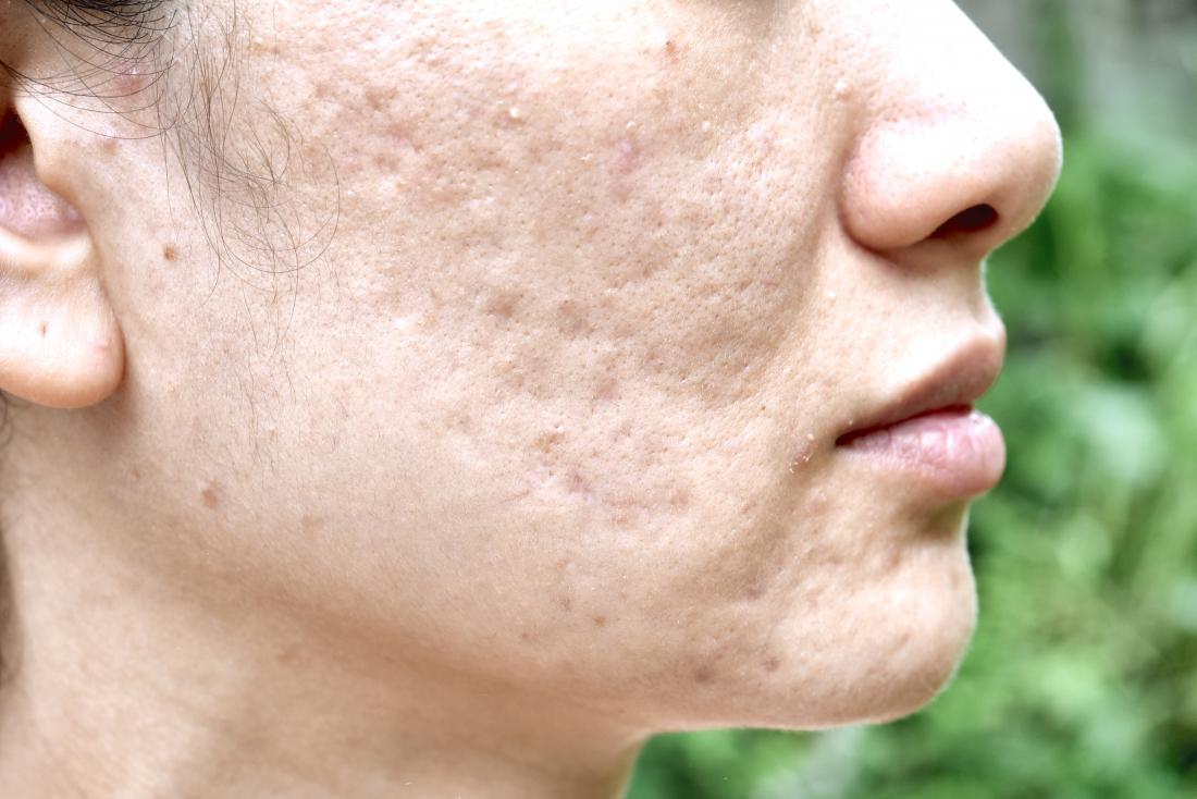 Cómo eliminar las cicatrices del acné: Tratamientos y caseros