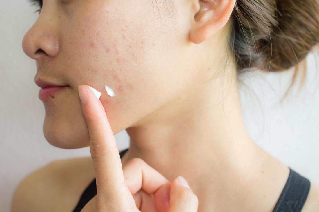 Woman with acne scars applying lotion, cream, or treatment to skin on face.