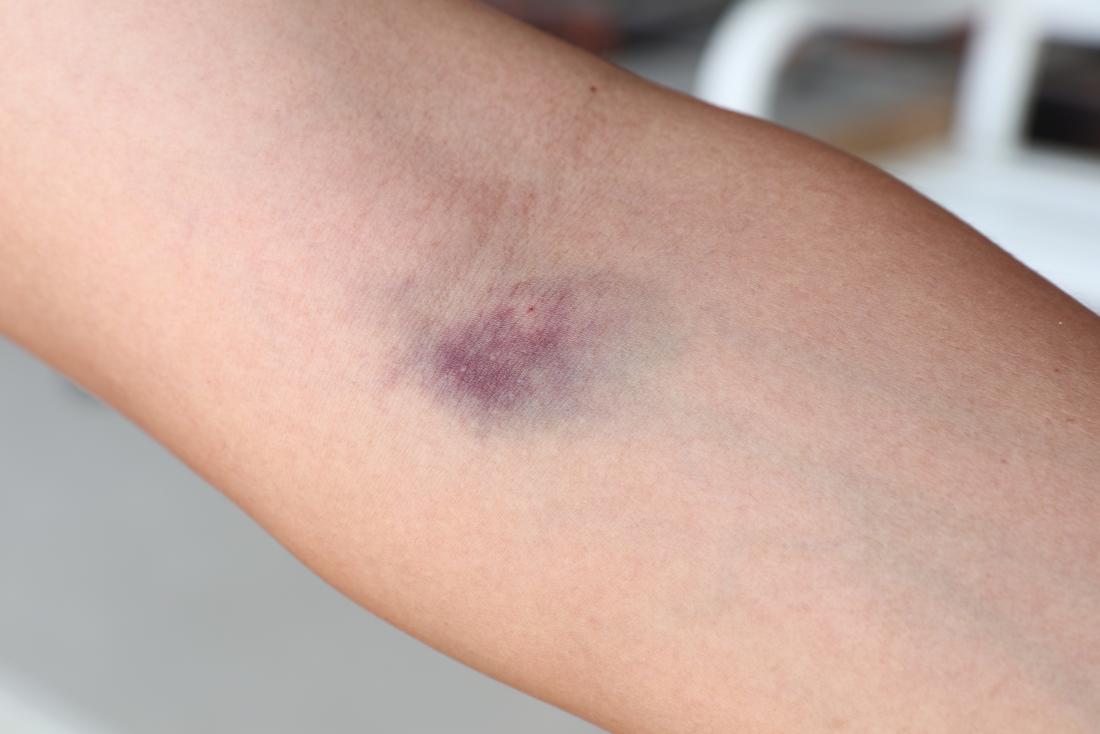 alcohol-and-humira-injection-bruise.jpg