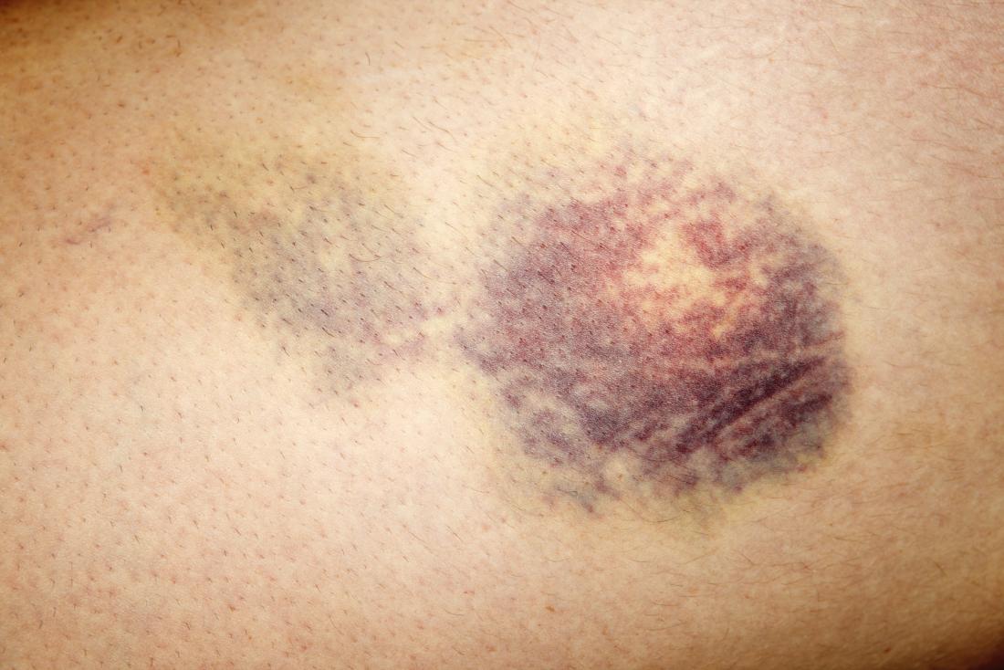 Fases De Um Hematoma - LIBRAIN