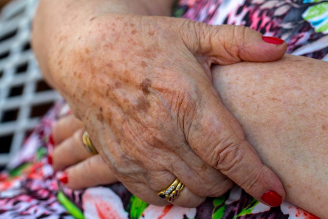 black dots on hands