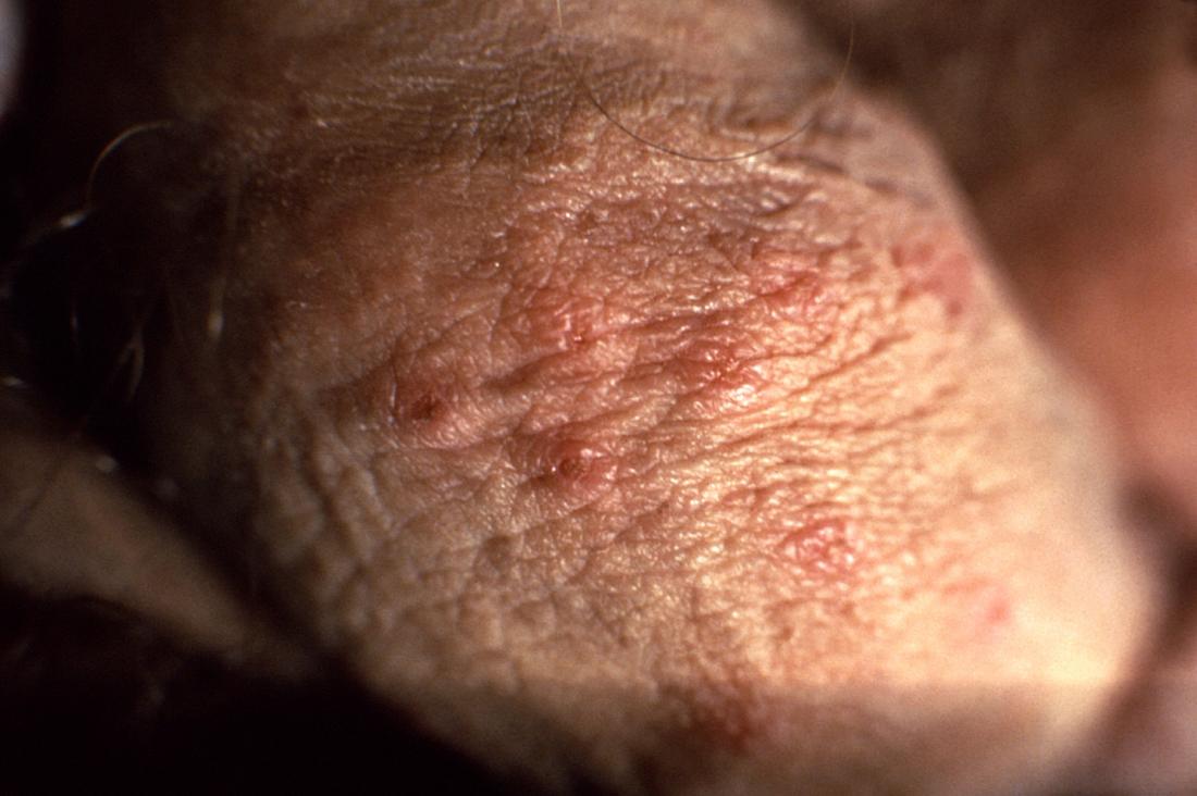 Fotos de herpes genital feminina
