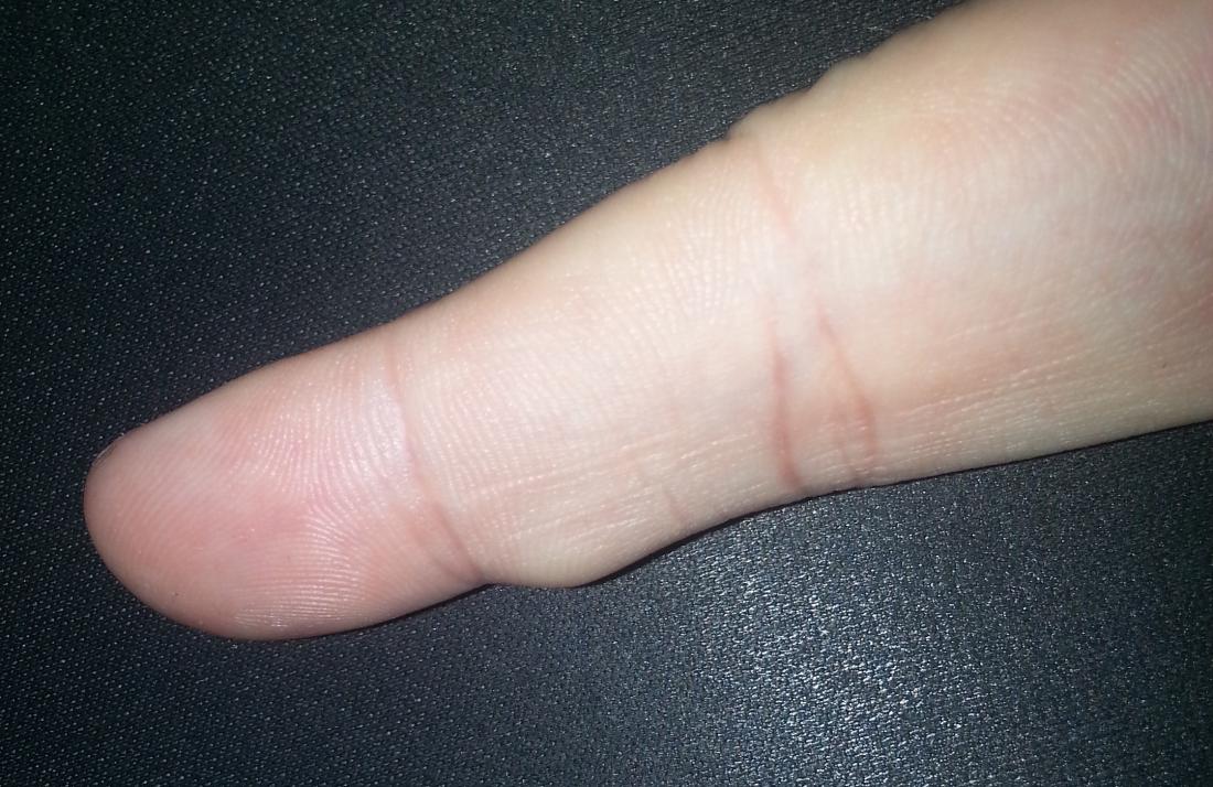 small painful bump on finger under skin