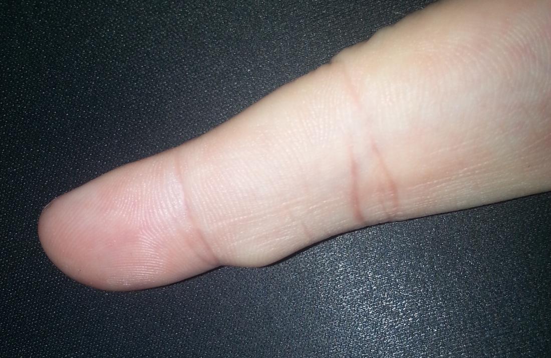 What Is This Hard White Bump On My Finger