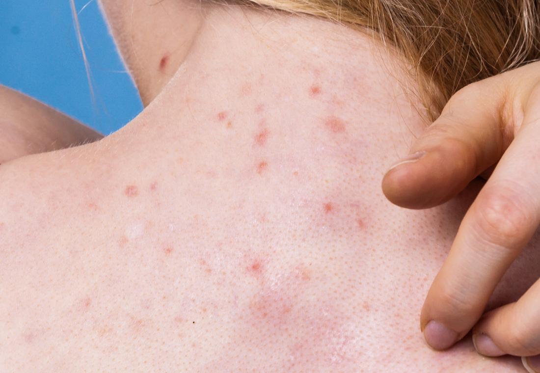 why-red-spots-are-suddenly-showing-up-on-your-skin-red-skin-spots