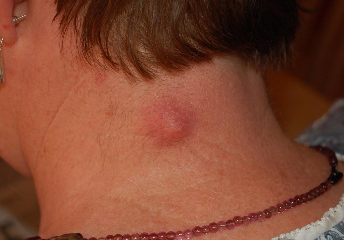 lymph nodes sore in back of neck