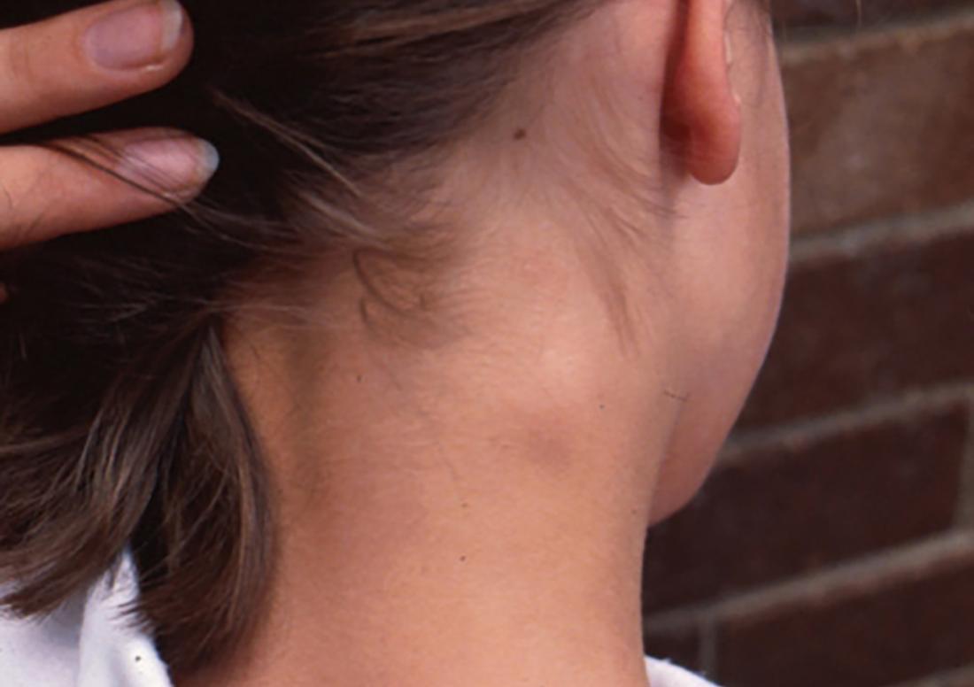 Swollen lymph nodes on back of neck. Image credit: Hudson, Bernard, 2010.