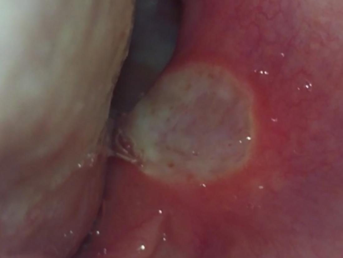 Red Spots On Roof Of Mouth Causes And Other Symptoms