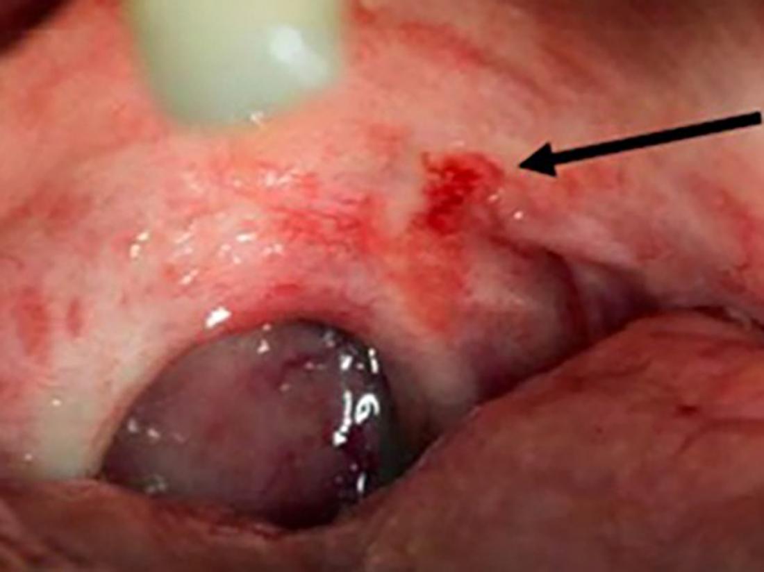 Nat sammen hjemmehørende Red spots on roof of mouth: Causes and other symptoms