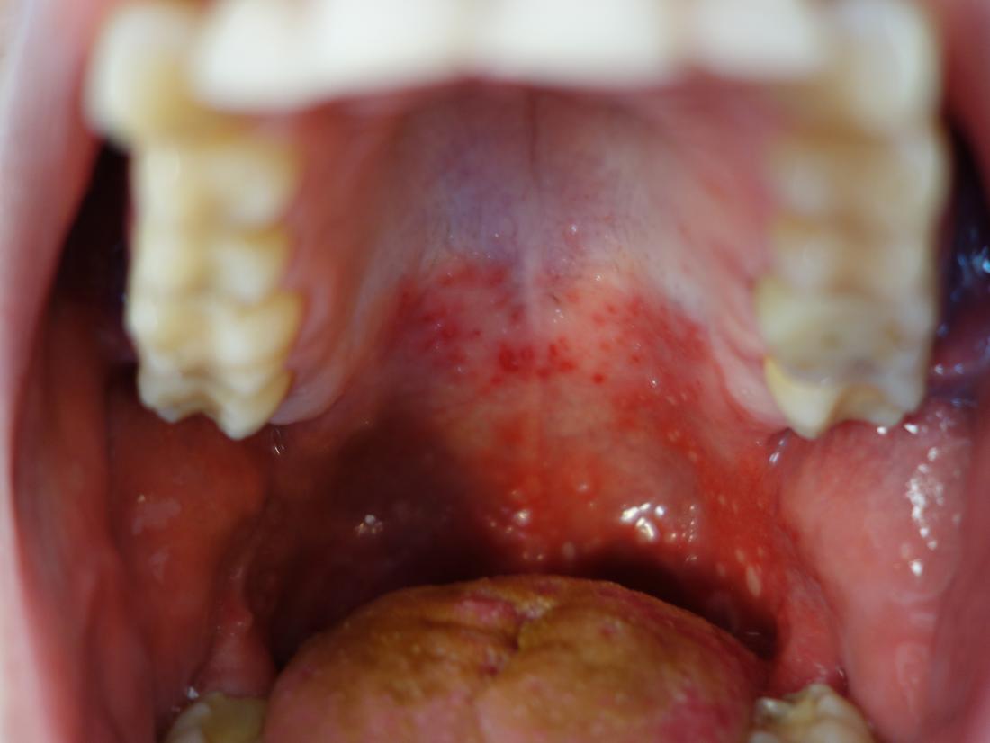 Allergic reaction rash inside mouth