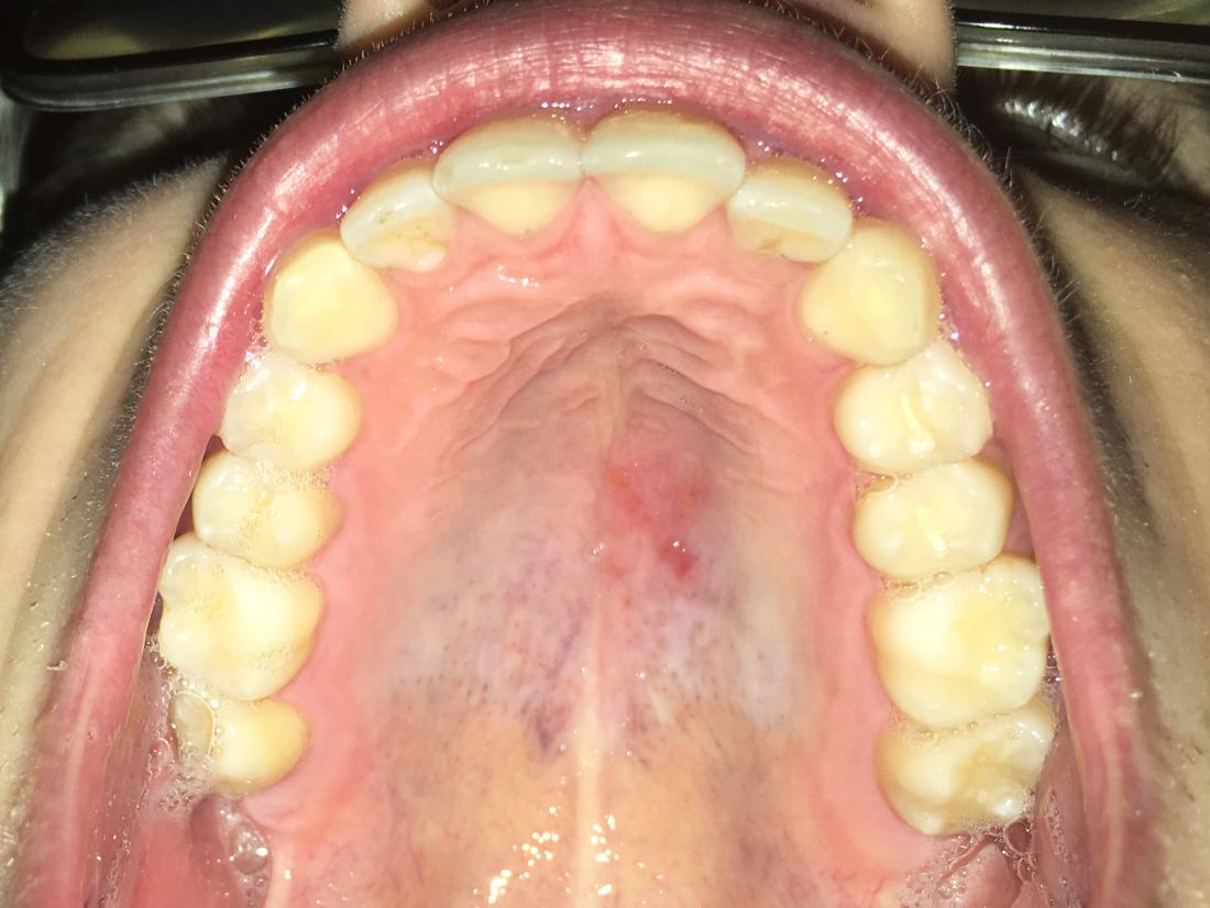 Nat sammen hjemmehørende Red spots on roof of mouth: Causes and other symptoms