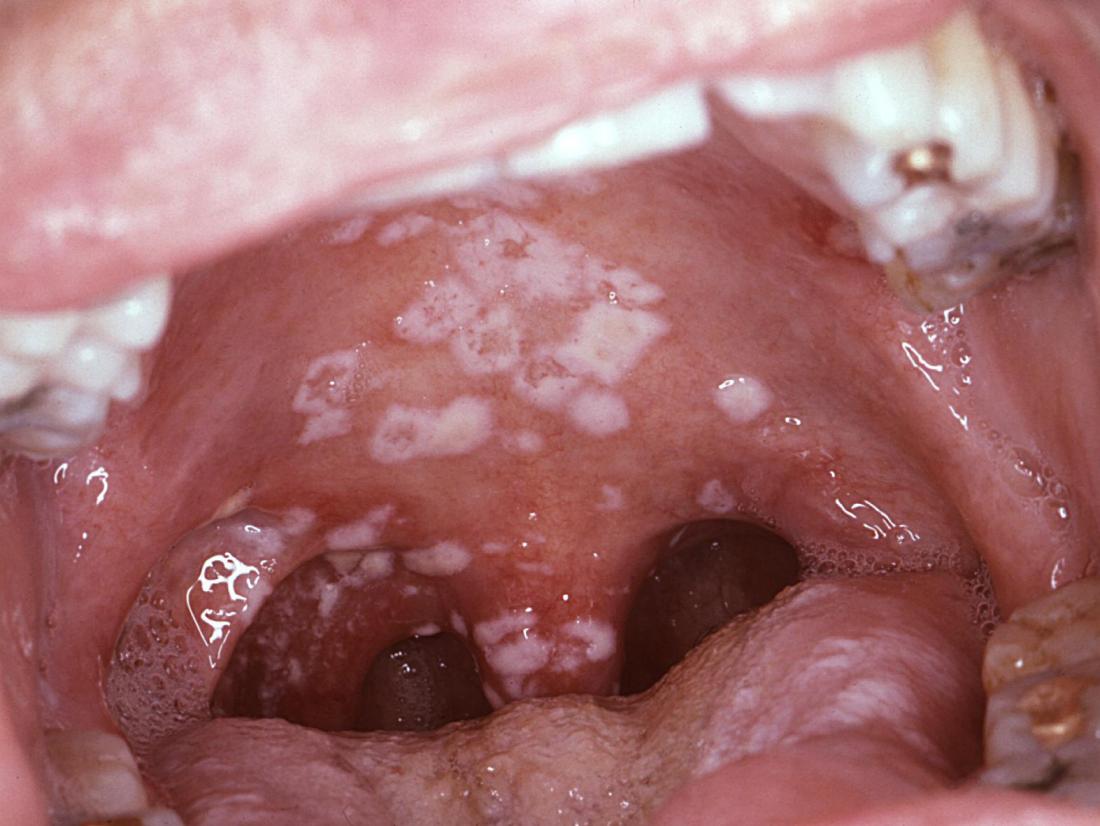 Red Spots in the Mouth  How to Treat Red Spots on Roof of Mouth