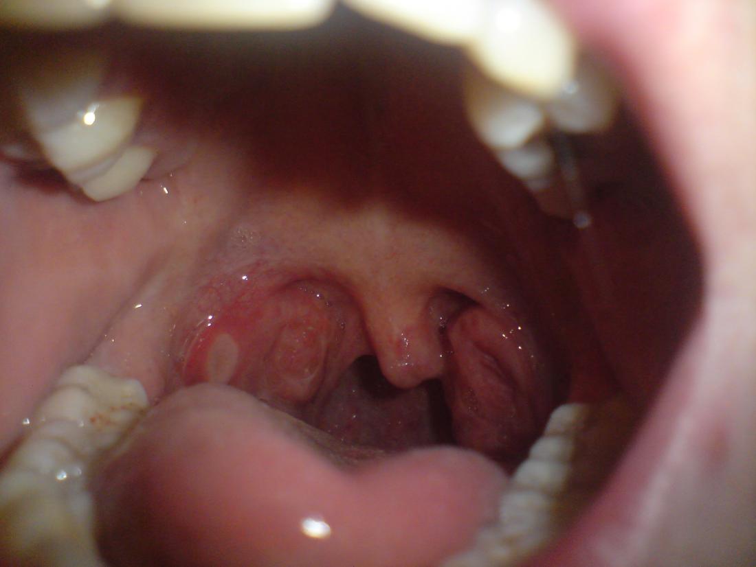 Red spots on roof of mouth: Causes and other symptoms