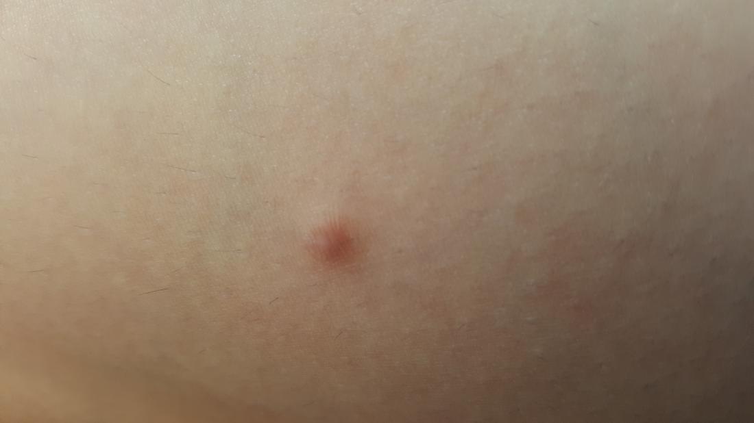 Hard Lump Under The Skin Causes And Pictures