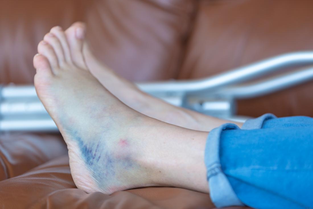 Bruised heel remedies and when to see a 