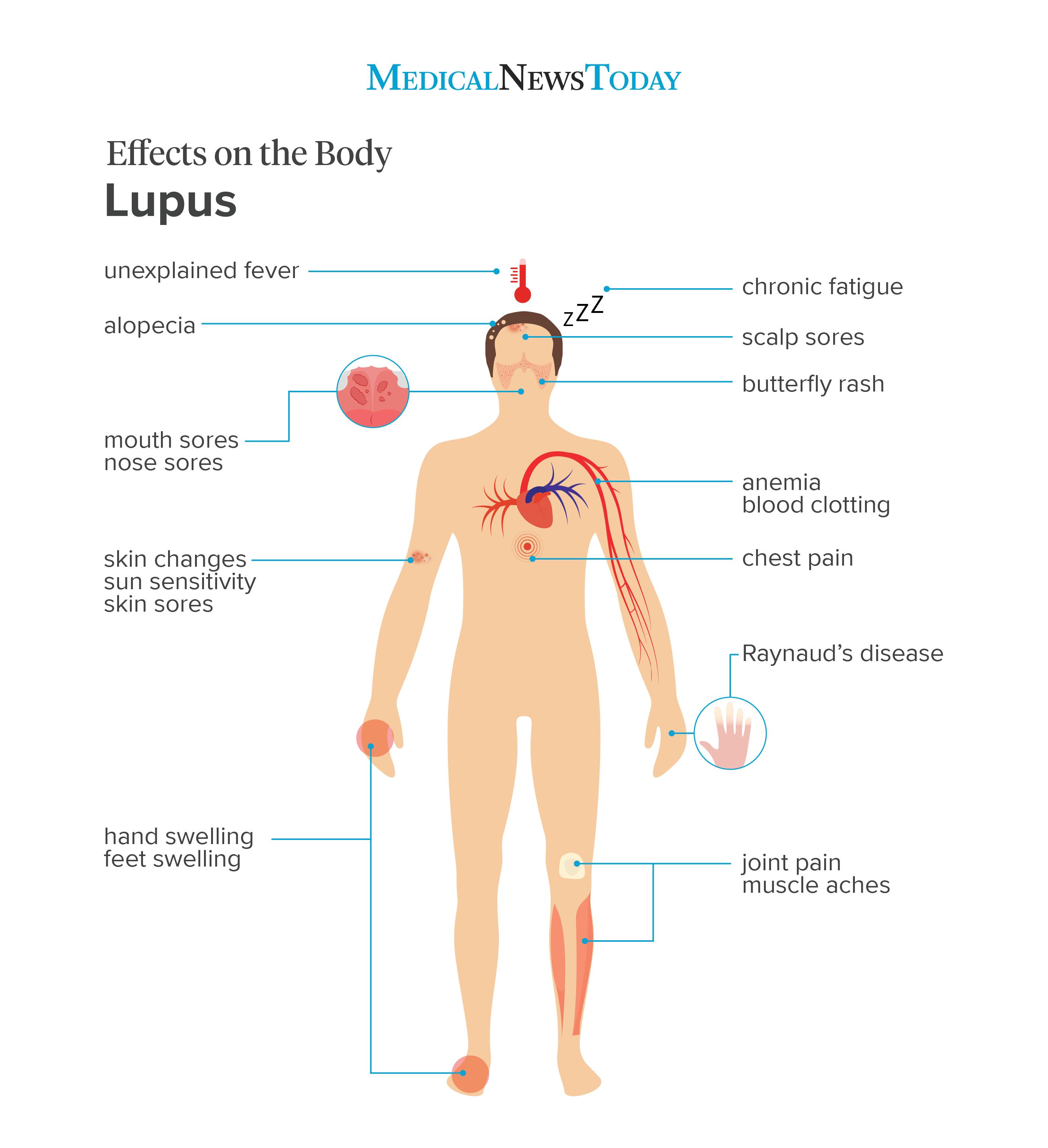 an infographics showing the effects on the body of lupus 