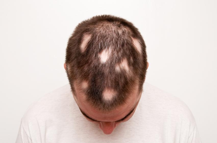 man with alopecia