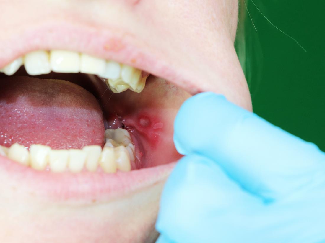 canker-sore-aphthous-ulcer-what-it-is-causes-treatment