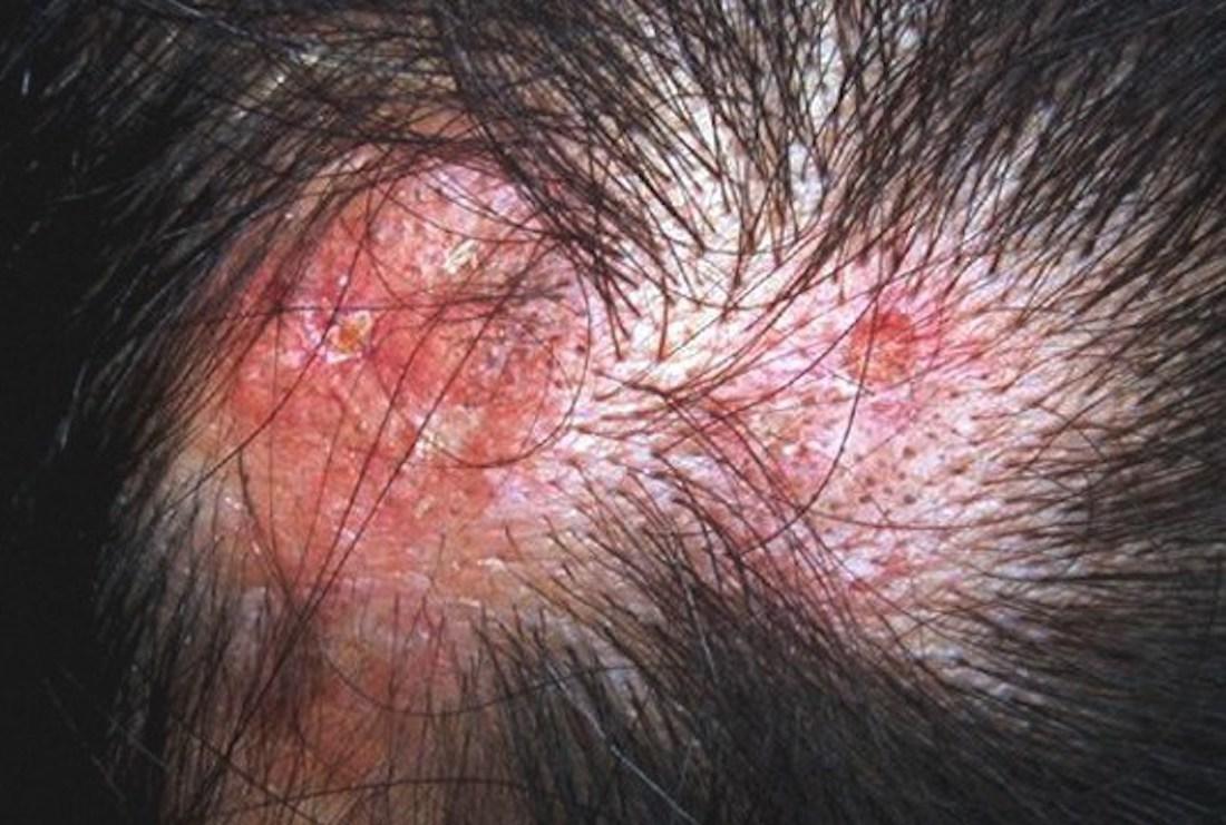 Red Spots On Scalp And Hair Loss - vrogue.co