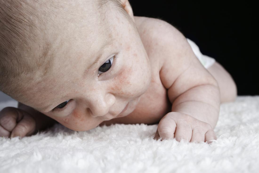 Dry skin on a baby's face: and remedies