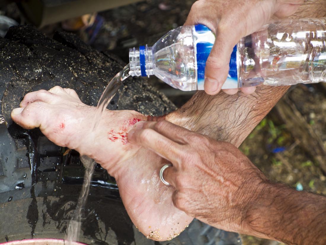 man washing wound on his foot with water