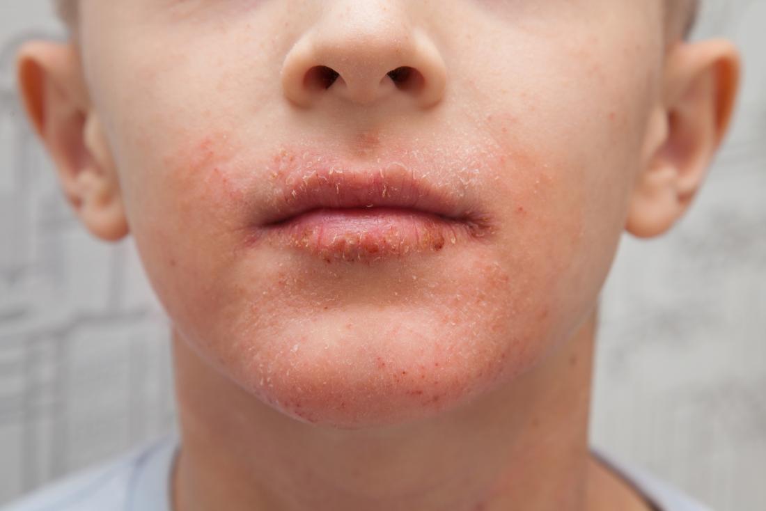 What Can Cause A Rash Around A Child s Mouth Other Allergies