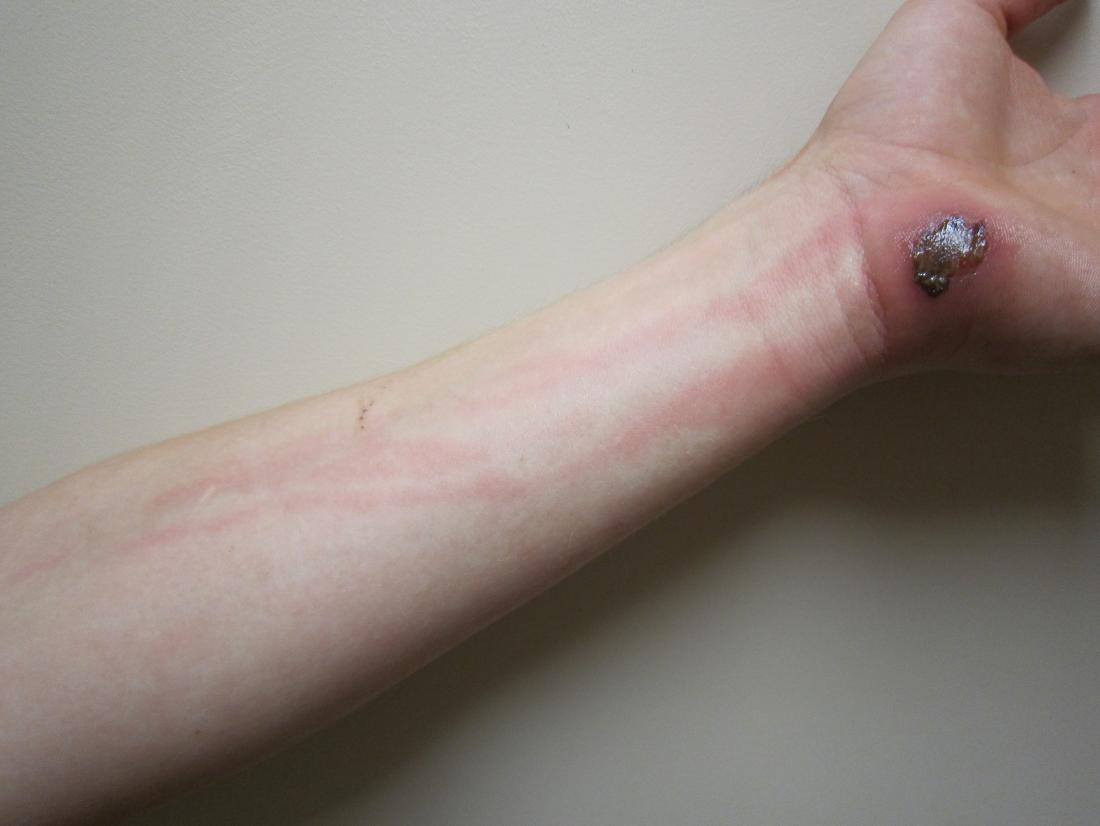 What Infection Causes Red Streaks On Skin