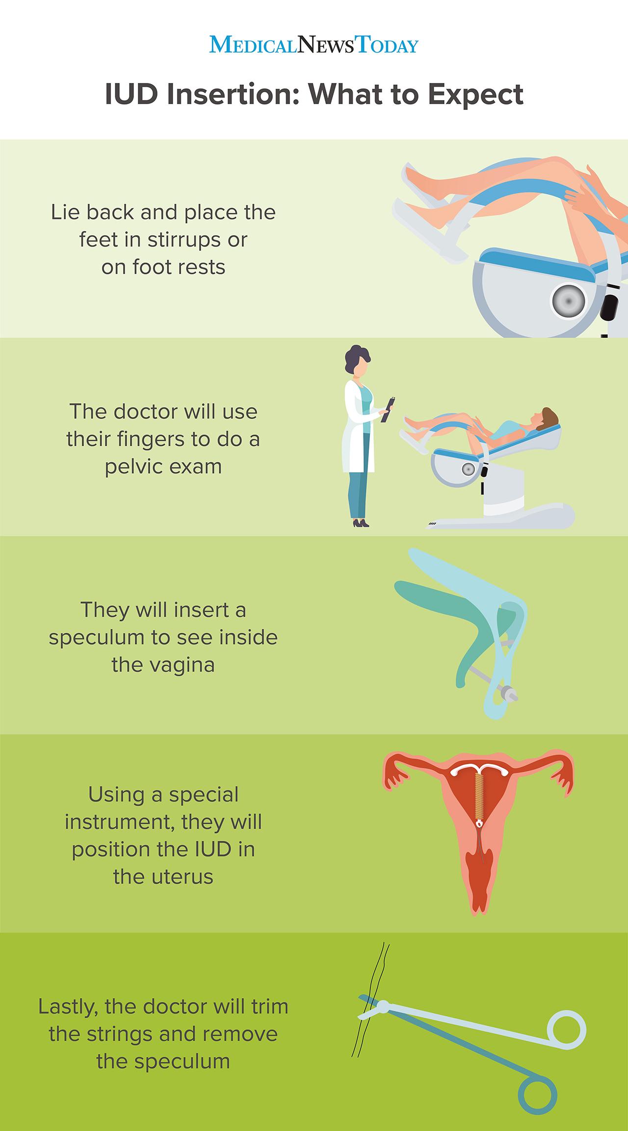 Iud Insertion A Guide And What To Expect