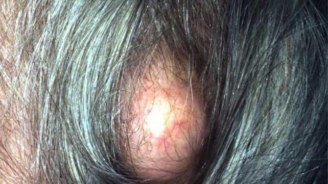 Bump On The Back Of The Head Causes And When To See A Doctor 