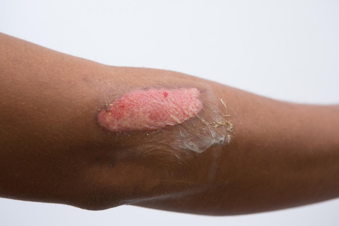 Nursing Management Of Second Degree Burn at Harry Tucker blog