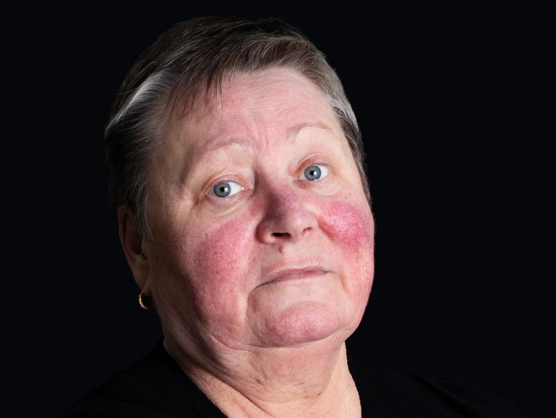 Butterfly rash.