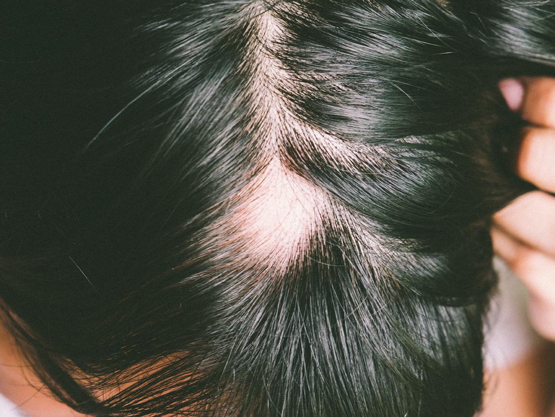Hair loss.