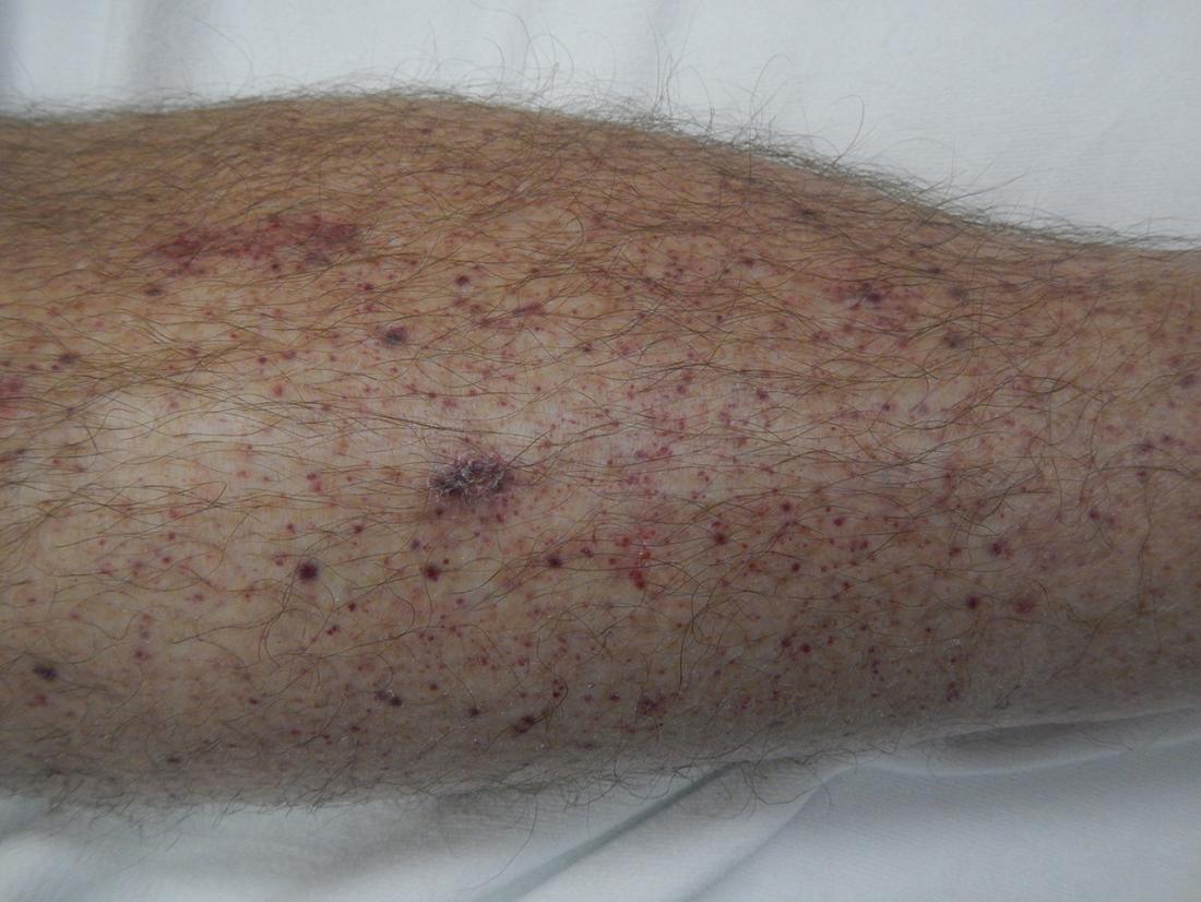 petechiae. Image credit: James Heilman, MD, 2016