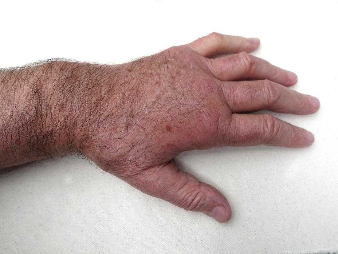 Swollen joints in wrist.