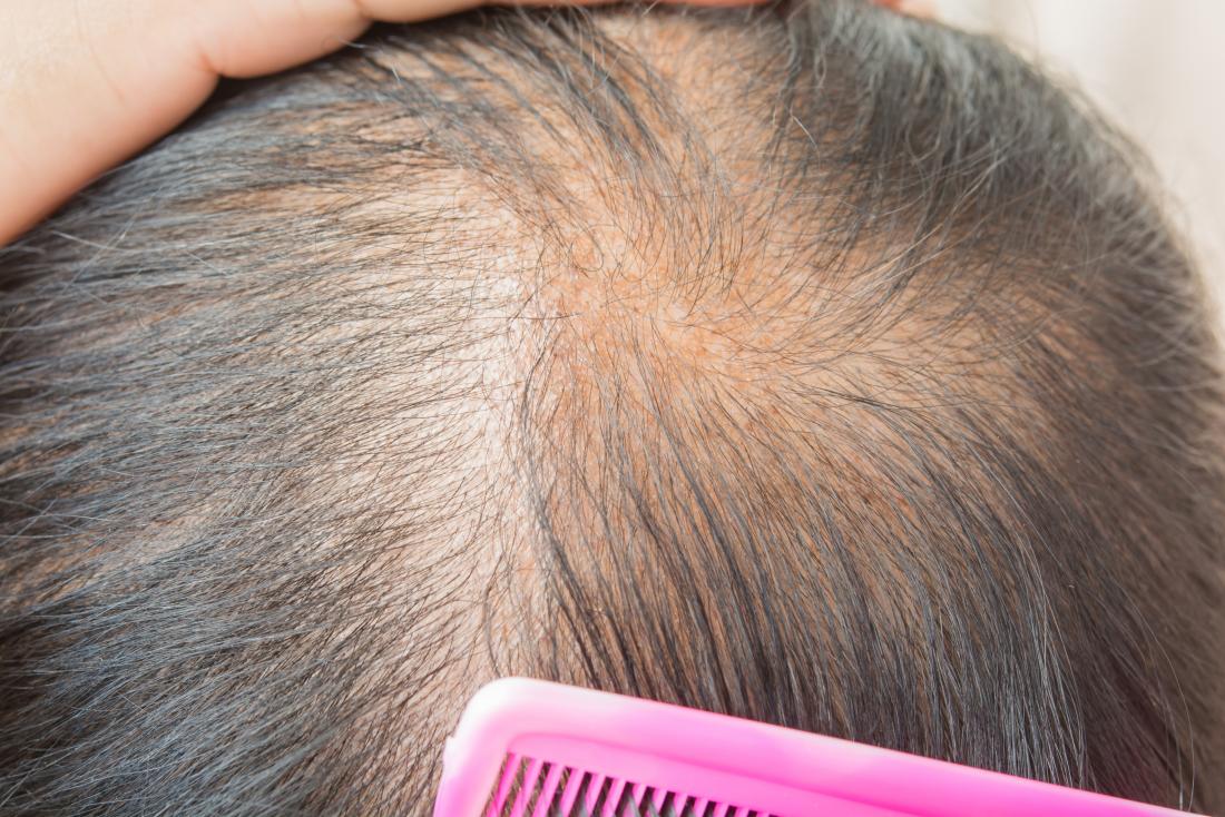 Thinning hair: Causes, types, treatment, and remedies