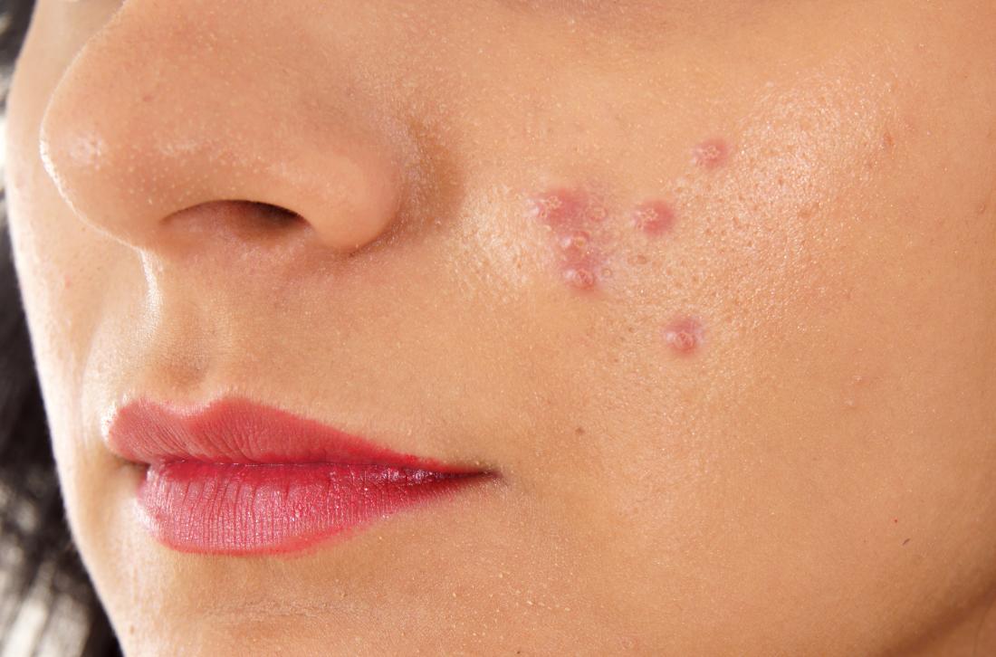 Small Red Pimples On Face