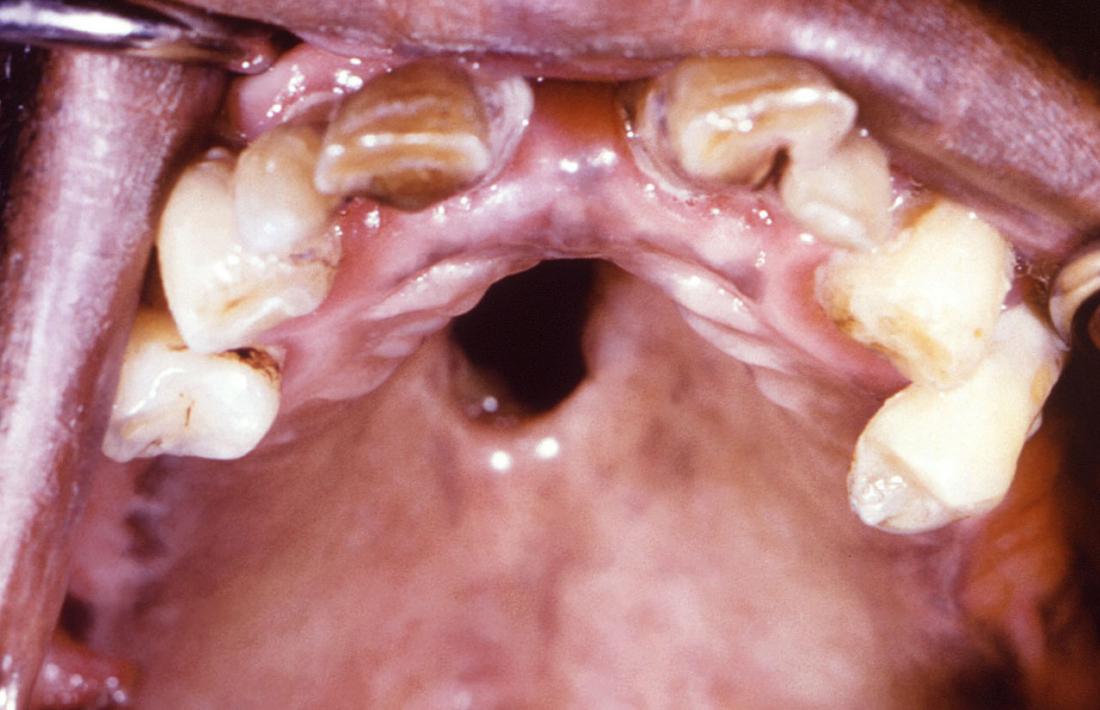 what does chlamydia look like in the mouth