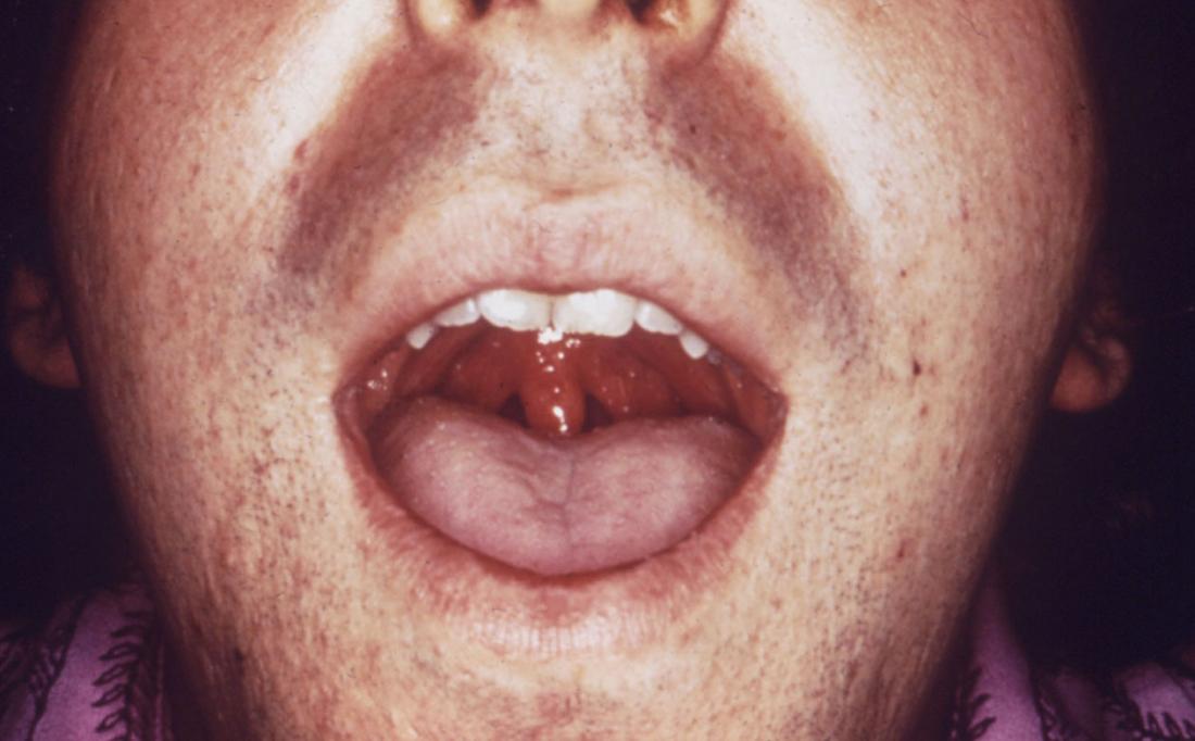 View Chlamydia Hpv Bumps On Tongue Pics