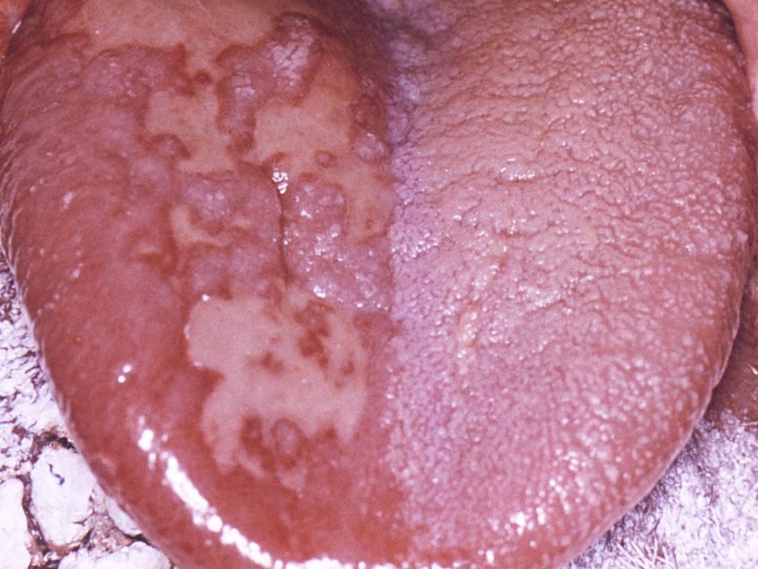 gonorrhea on tongue